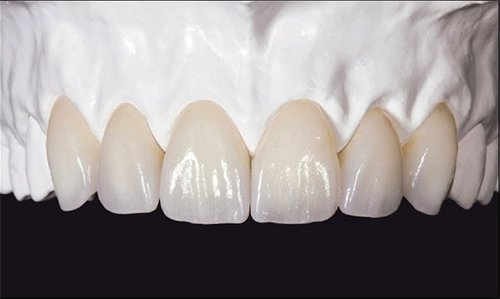 Răng sứ zirconia có tốt không? 