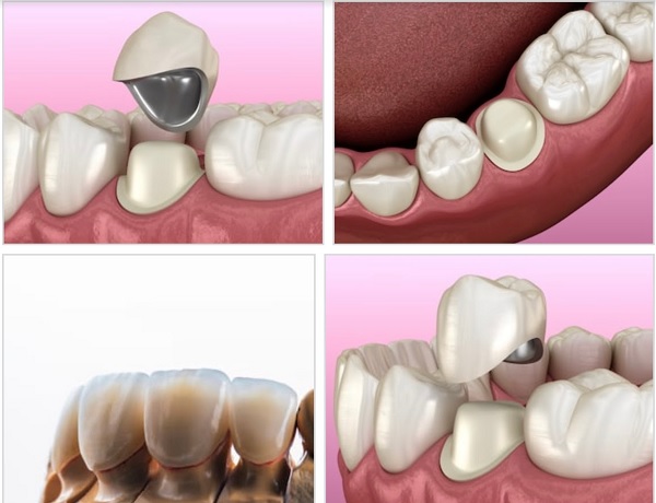 So sánh sự khác biệt của răng sứ kim loại và răng sứ Titan