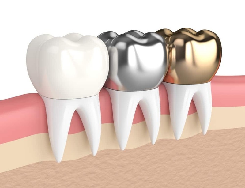 So sánh sự khác biệt của răng sứ kim loại và răng sứ Titan