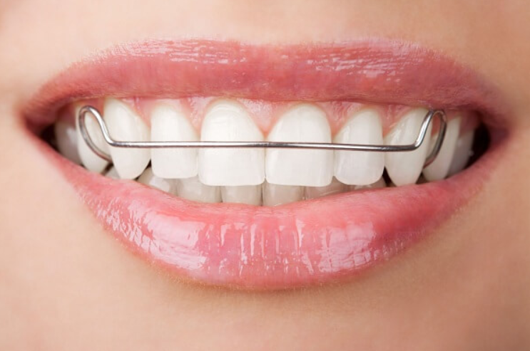 Sử dụng hàm duy trì như thế nào cho đúng cách để tránh tình trạng niềng răng xong bị chạy răng?