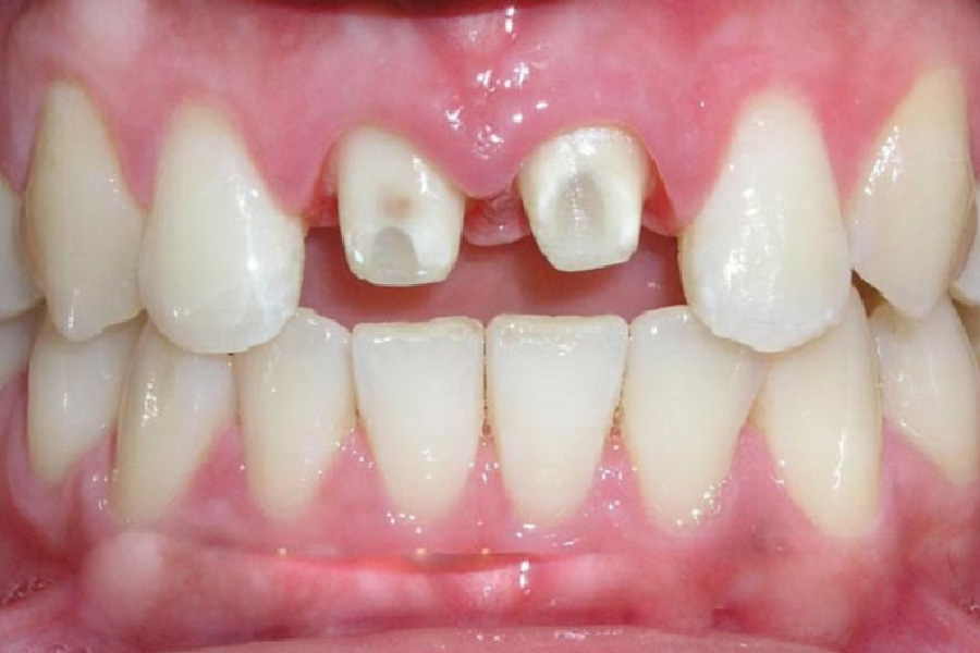 Tác hại của việc bọc răng sứ bị tụt lợi