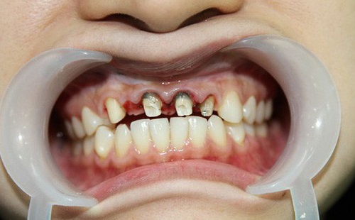 Tại sao bọc răng sứ bị hỏng? 