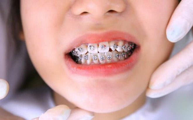 Trường hợp nào có thể niềng răng bằng mắc cài kim loại 3M?