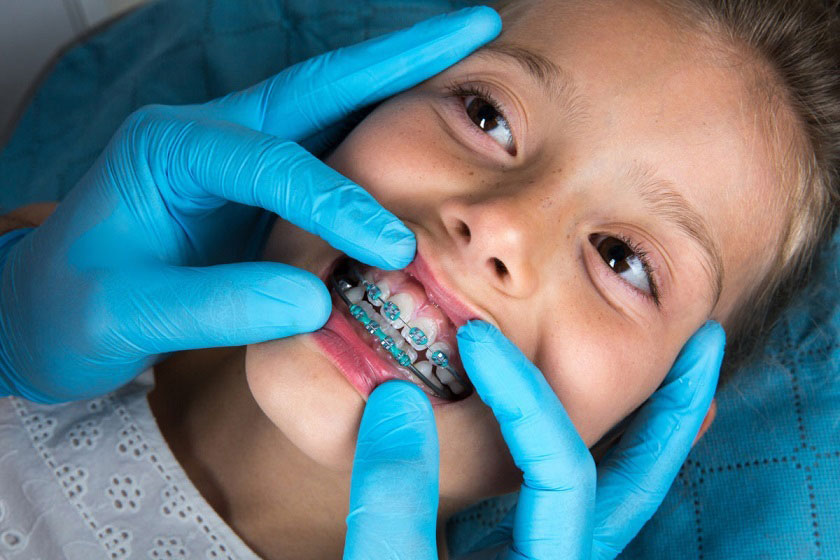 Có nên niềng răng cho trẻ 9 tuổi hay không?
