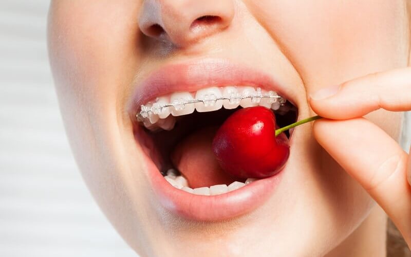 ưu ý ăn uống khi niềng răng