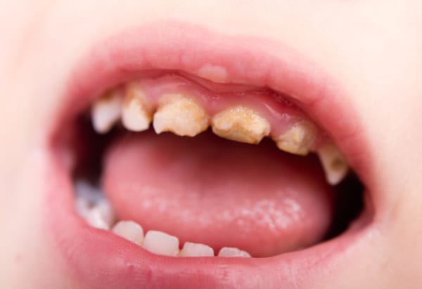 Điều trị tình trạng sâu răng hàm ở trẻ