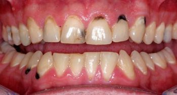 răng trẻ em bị đốm đen
