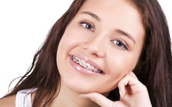 6 nguyên nhân gây hóp má, thái dương khi niềng răng