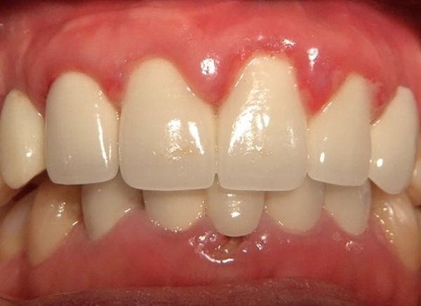 Ảnh hưởng của bọc răng sứ bị đau nướu 