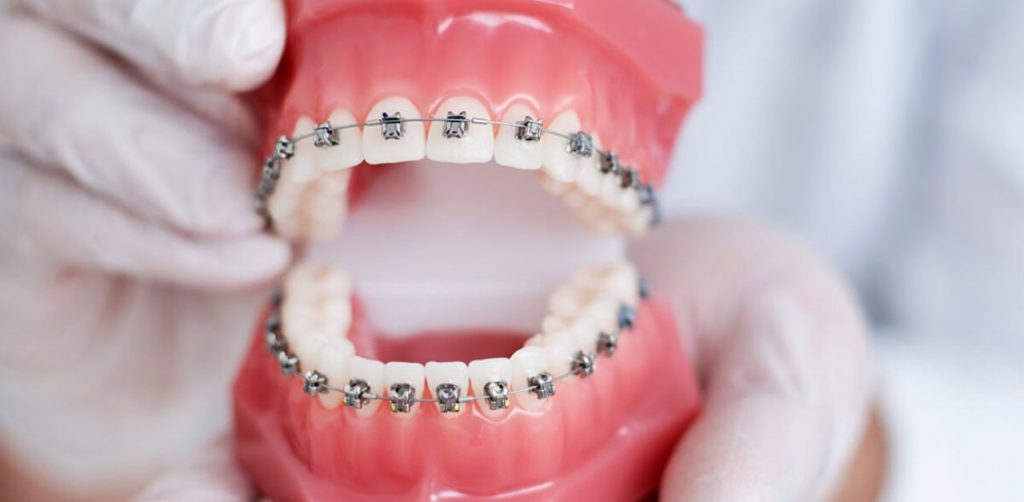 Bị viêm lợi có niềng răng được không?