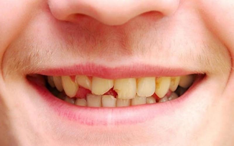Bọc răng sứ cho răng cửa bị mẻ được áp dụng khi nào?