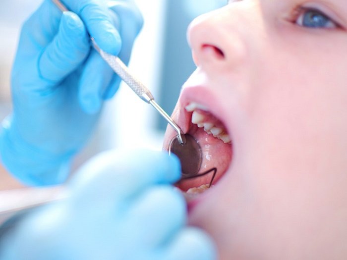 Các phương pháp chữa sâu răng cho trẻ 2 tuổi hiệu quả