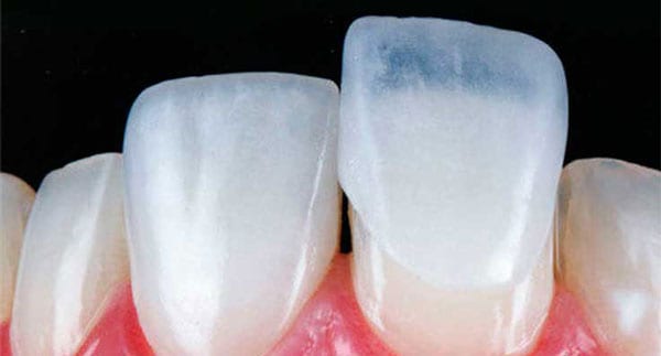 Cách chăm sóc răng khi dán sứ Veneer