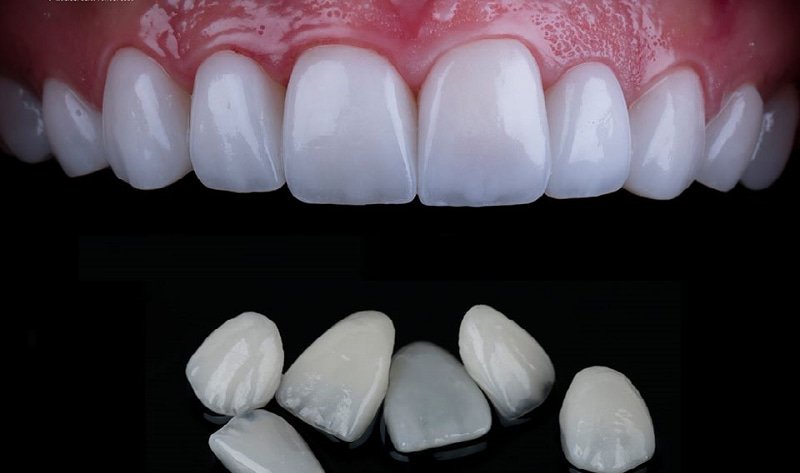 Cách chăm sóc răng sau dán sứ Veneer đúng cách