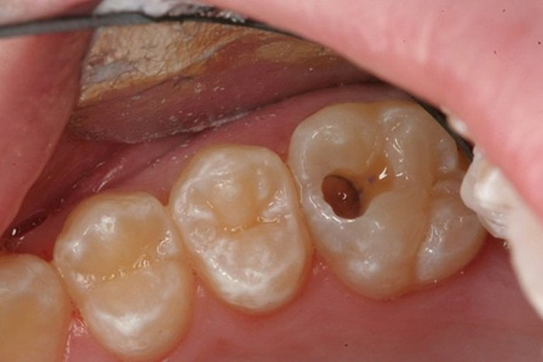 Cách điều trị khi trẻ em bị sâu răng cấm