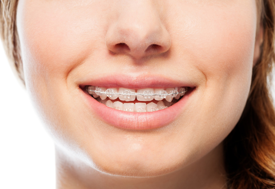 Làm thế nào để phòng ngừa tình trạng lệch mặt sau niềng răng?