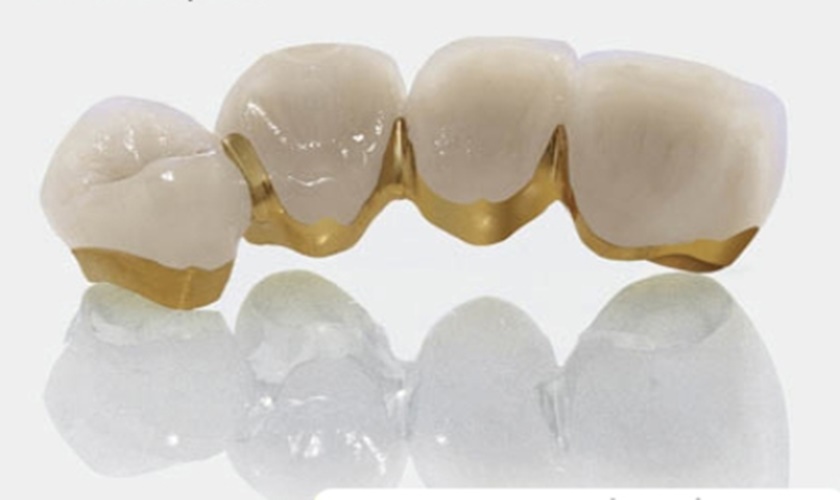 Cách nhận biết răng sứ titan qua nhược điểm của nó 