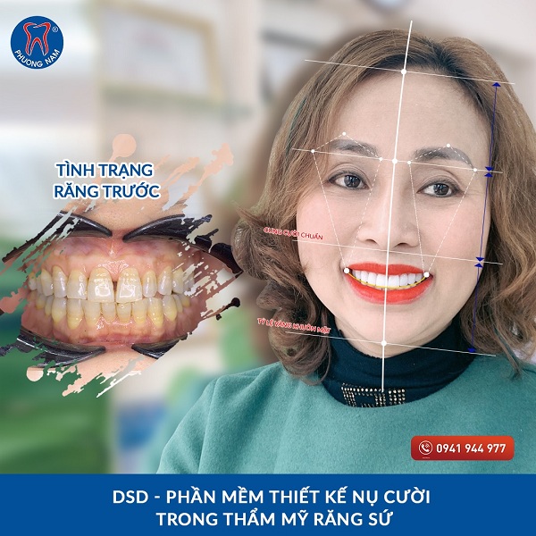 Có nên lựa chọn Nha khoa Phương Nam để thực hiện quy trình bọc răng sứ titan