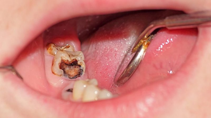 Giải pháp điều trị khi trẻ bị sâu răng ăn vào tuỷ