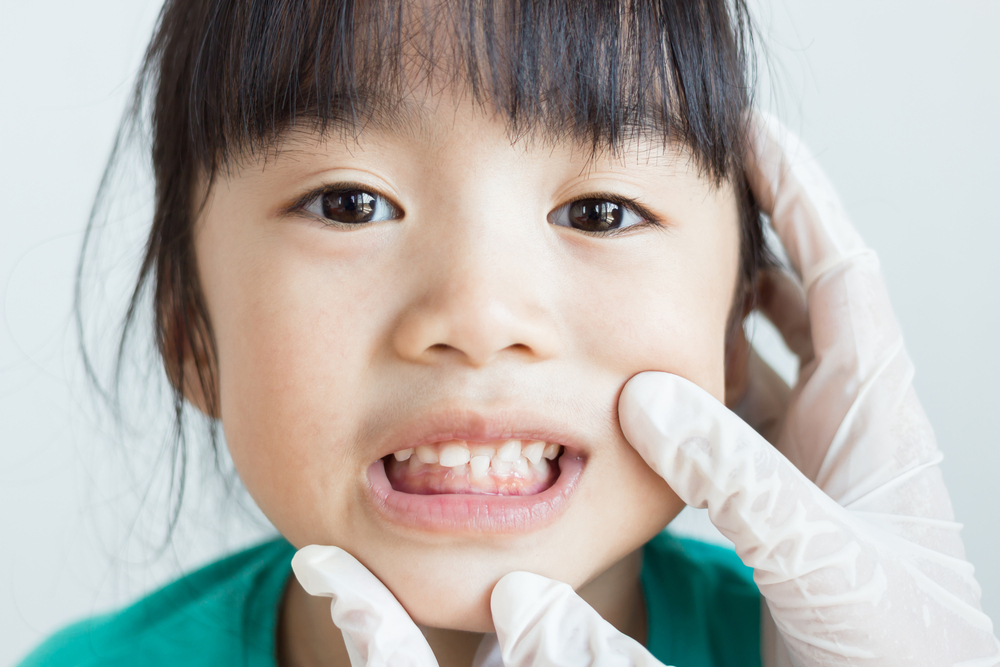 Khi nào cần niềng răng trẻ em?