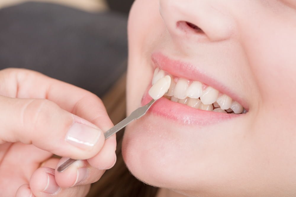 Vấn đề răng miệng nào có thể khắc phục bằng Veneer nha khoa?
