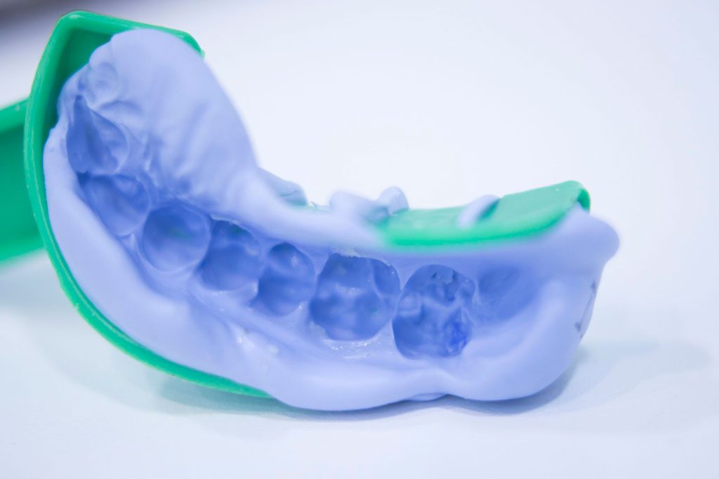 Lấy dấu răng giúp cho việc chế tác răng sứ tại nha khoa Phương Nam