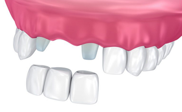 Lợi ích của việc bọc răng sứ cho răng bị bể lớn 