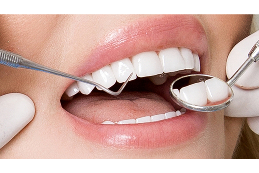 Lợi ích của việc bọc răng sứ cho răng cửa