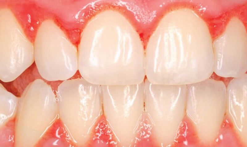Nguyên nhân dẫn đến tình trạng bọc răng sứ bị đau nướu