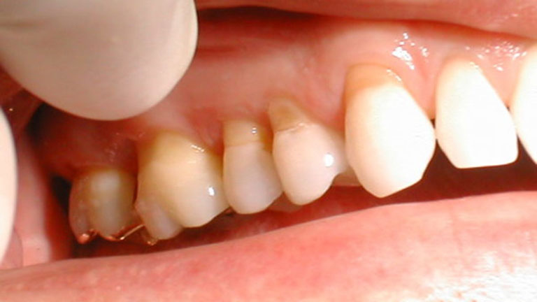 Nguyên nhân dẫn đến tình trạng mòn chân răng sữa ở trẻ