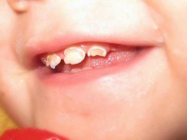 Nguyên nhân gây bệnh ăn mòn chân răng ở trẻ em