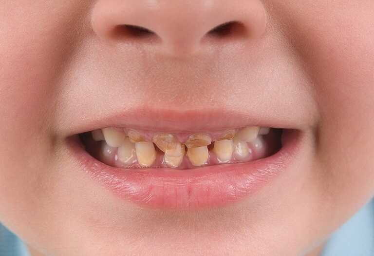 Nguyên nhân khiến răng trẻ em bị ố vàng