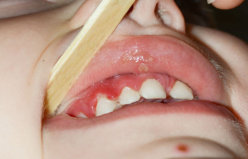 Nguyên nhân và triệu chứng viêm nướu răng ở trẻ em