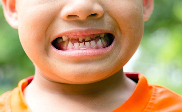 Nha khoa Phương Nam luôn chăm sóc răng cho trẻ trong cả quá trình 