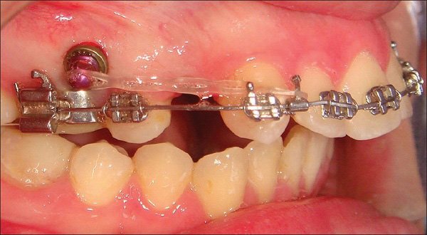 Nhổ răng khi niềng răng có hại không?