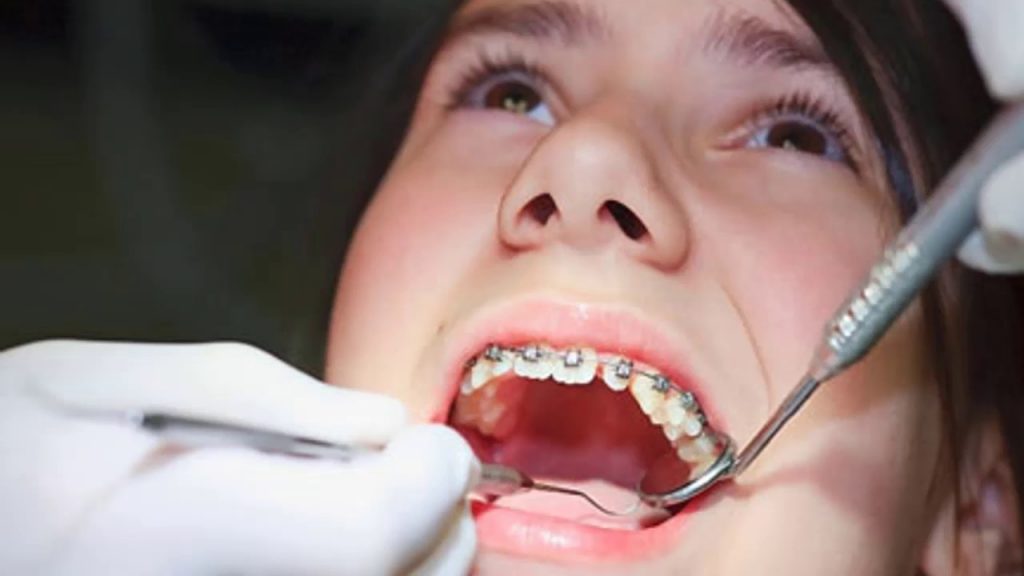 Những nguyên nhân của tình trạng niềng răng bị hôi miệng