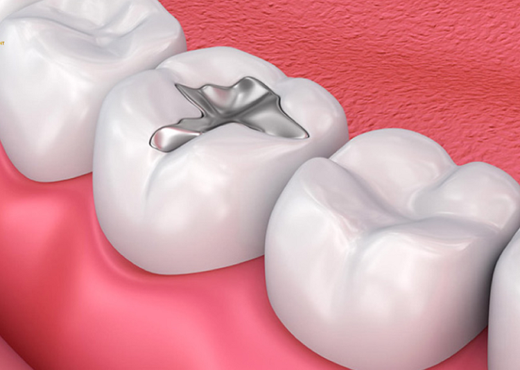 Những nguyên nhân gây ra tình trạng răng bị bể, mẻ, gãy vỡ