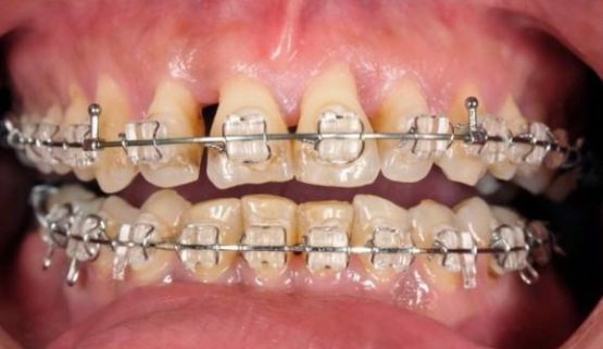 Những nguyên nhân làm dây thun niềng răng bị vàng