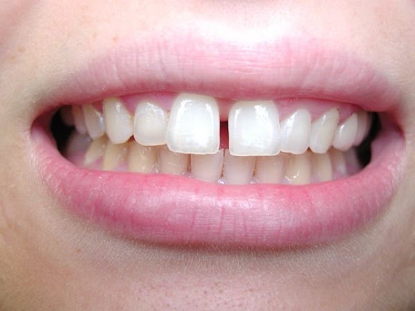 Những tác hại của răng thưa