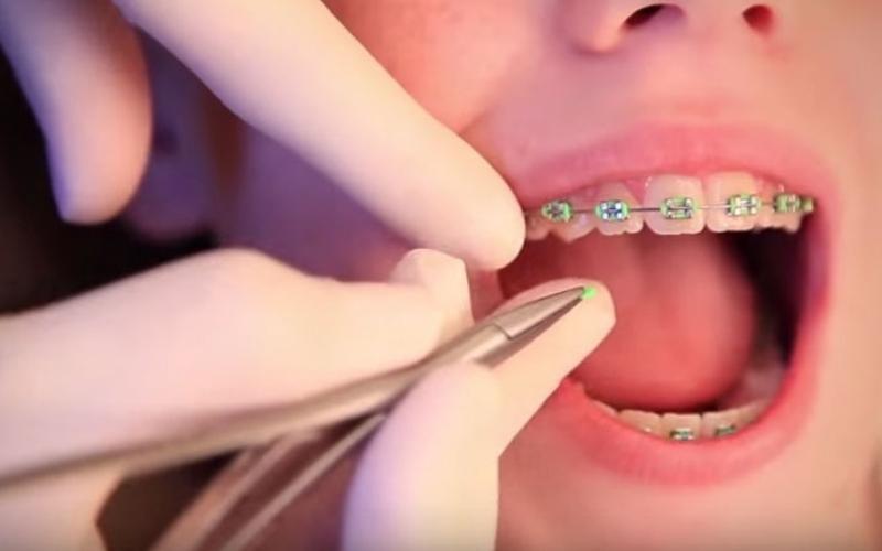 Niềng răng móm bao lâu phụ thuộc vào tình trạng răng miệng