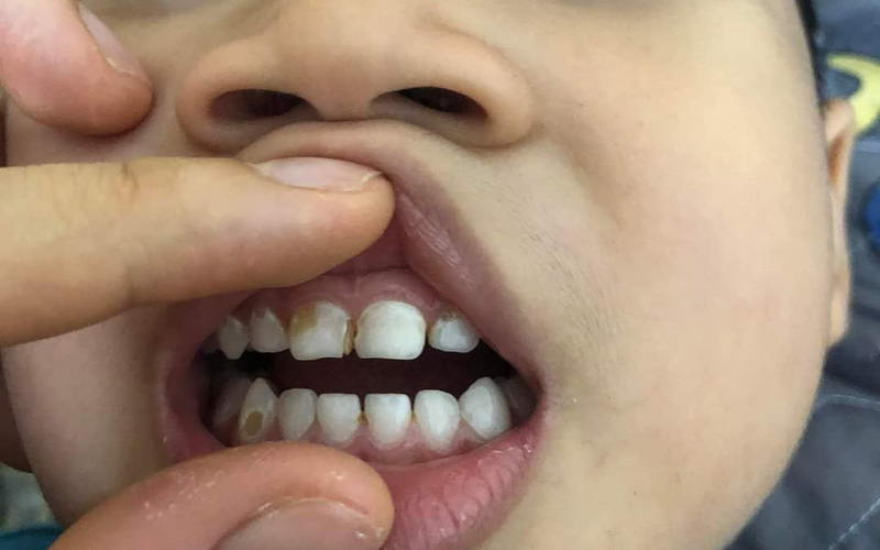 Phòng ngừa sâu răng ở trẻ em