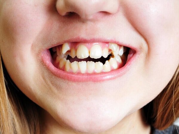 Phòng ngừa và điều trị sớm tình trạng răng trẻ em bị mọc lệch