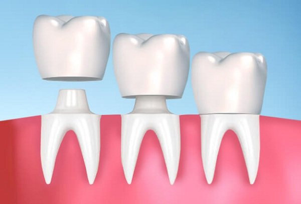Phương pháp điều trị tình trạng bọc răng sứ bị hôi miệng 