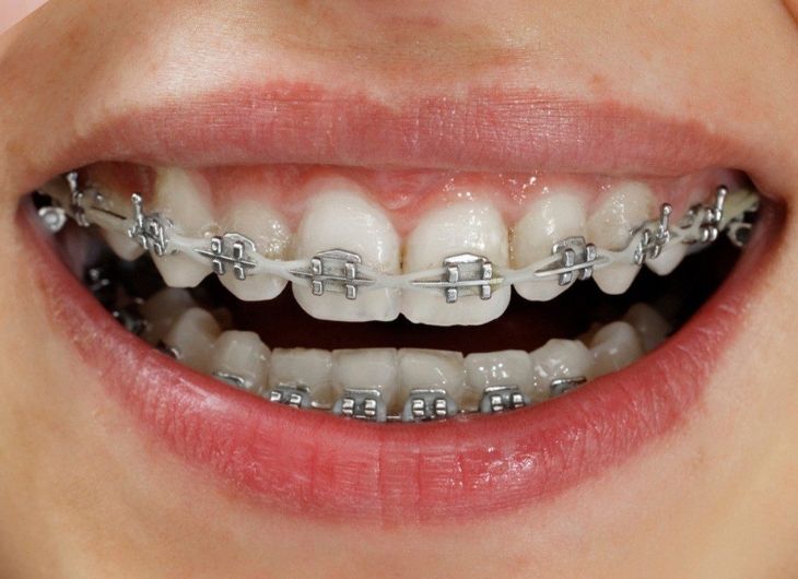 Phương pháp niềng răng mắc cài kim loại truyền thống cho răng thưa