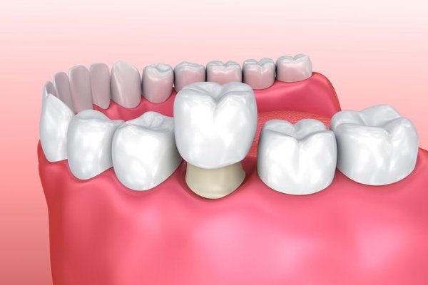 Quy trình bọc răng sứ cho răng sâu nặng 