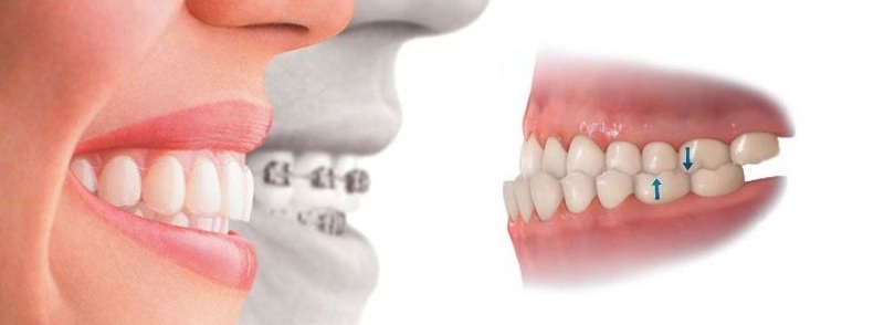 Răng bị móm là tình trạng răng thế nào?