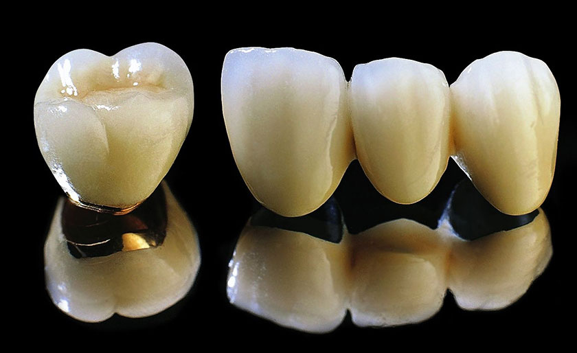 Răng sứ titan là gì?