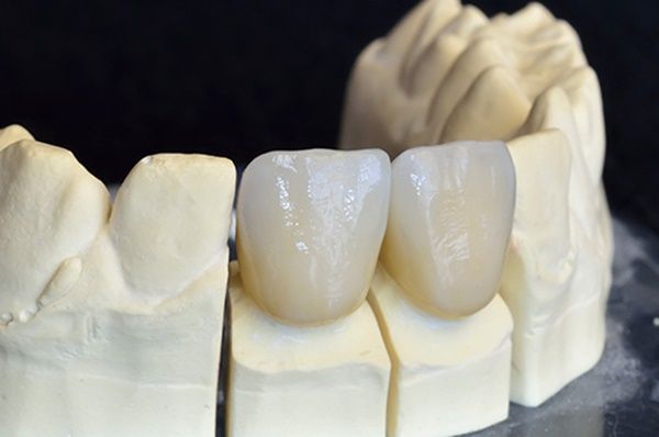 Răng sứ venus là gì?