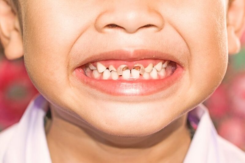 Sâu răng ở trẻ 1 tuổi