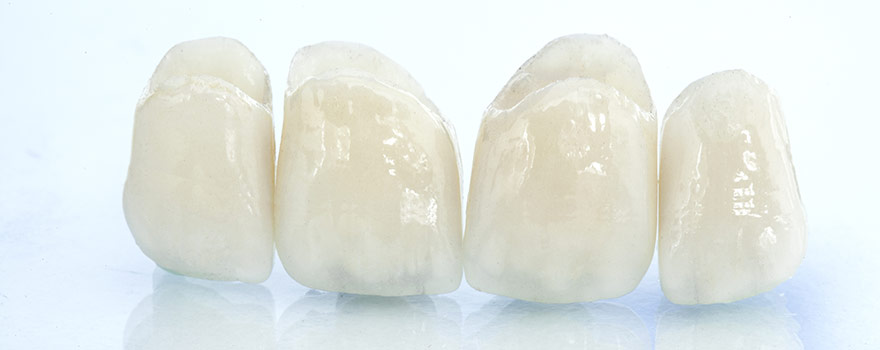 So sánh răng sứ cercon và zirconia về điểm giống nhau